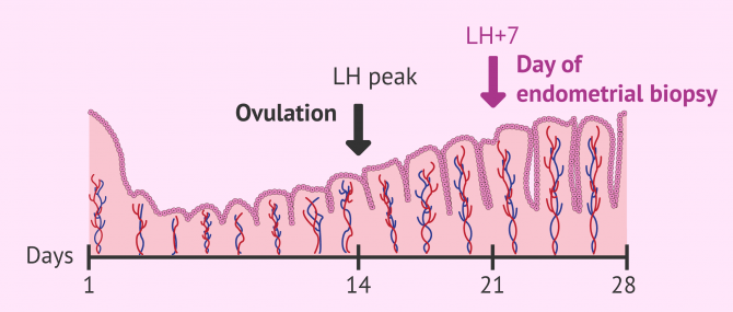 Imagen: When to perform endometrial biopsy for ERA