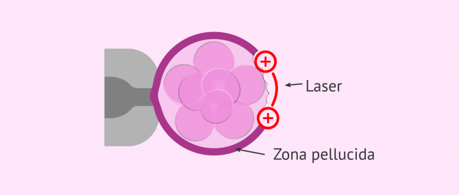 Imagen: Laser Assisted Hatching