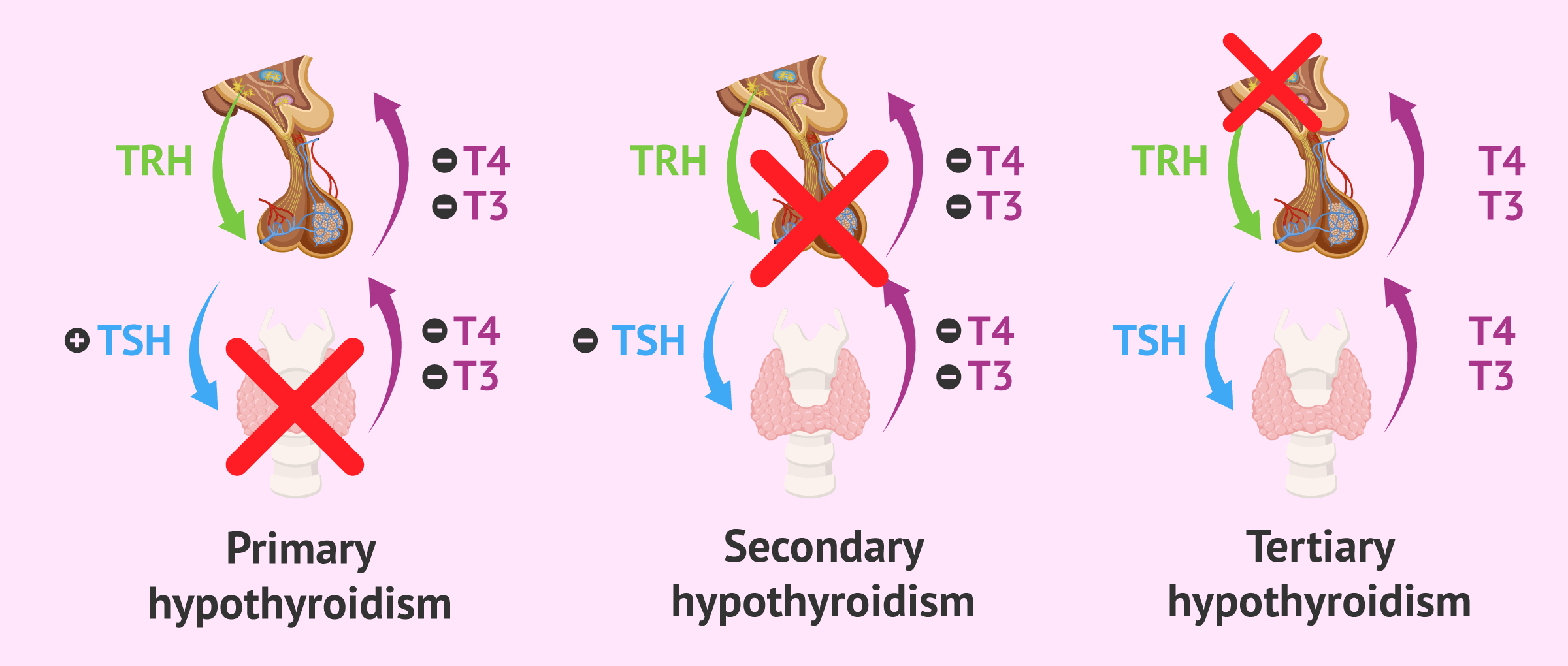 Differences Between Types Of Hypothyroidism