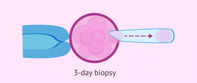 Imagen: Blastomere biopsy on day 3