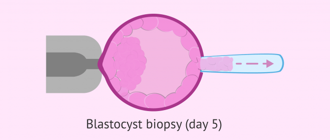 Imagen: Trophoectoderm biopsy on day 5