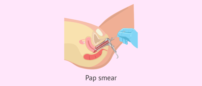 Imagen: Pap Smear