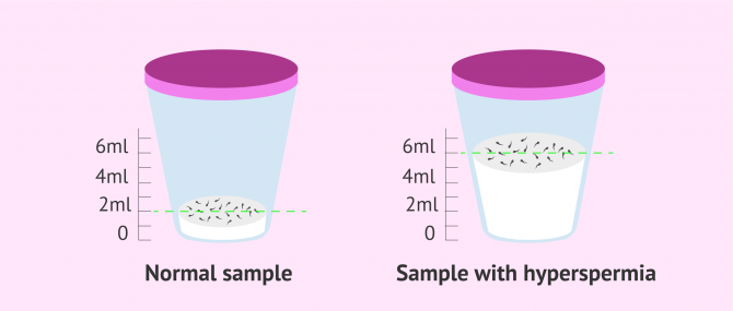 Imagen: Semen sample hyperspermia