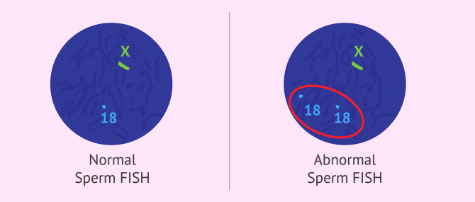 Imagen: Sperm FISH test