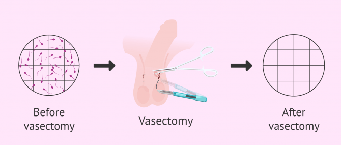 Imagen: Azoospermia after vasectomy