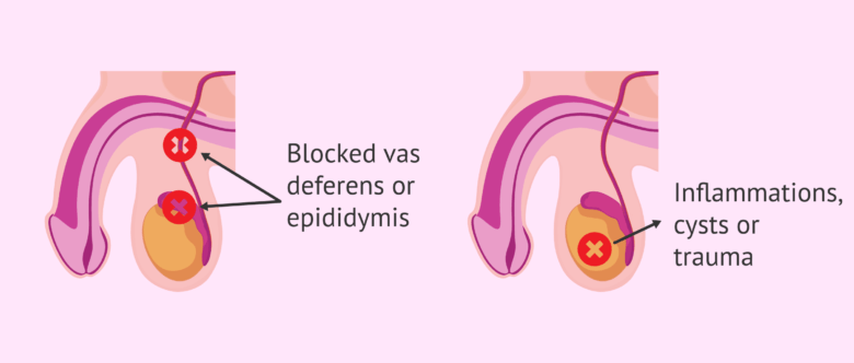 Imagen: Causes of obstructive azoospermia