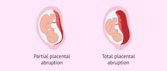 Total And Partial Placental Abruption