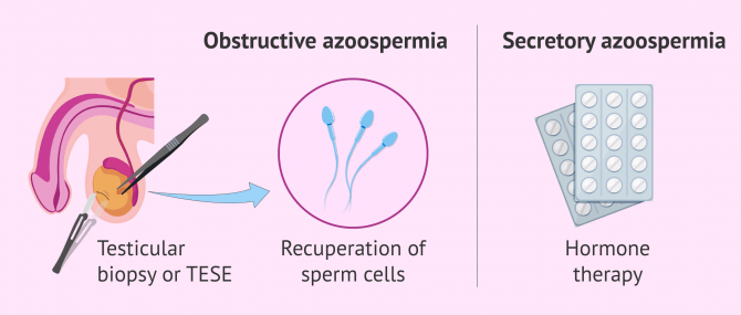 Imagen: Medical treatment for azoospermia