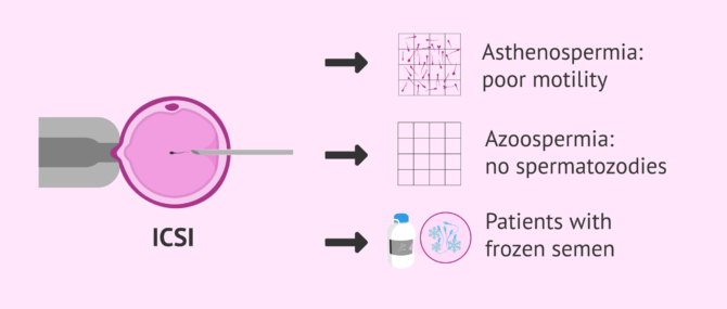 Imagen: ICSI as a solution for male infertility