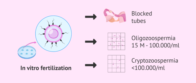 Imagen: IVF for fertility problems in men and women