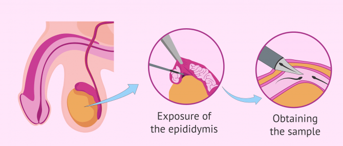 Imagen: Sperm aspiration from the epididymis by MESA