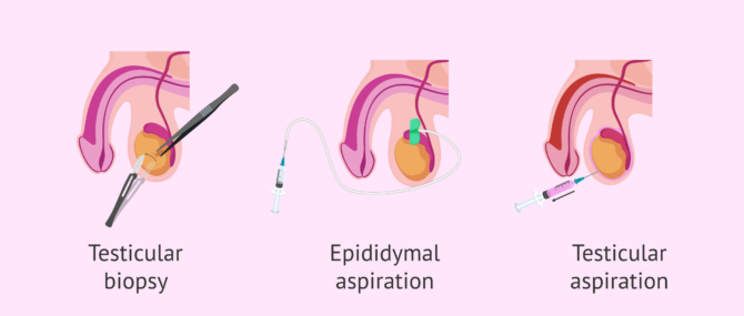 Imagen: Sperm retrieval methods