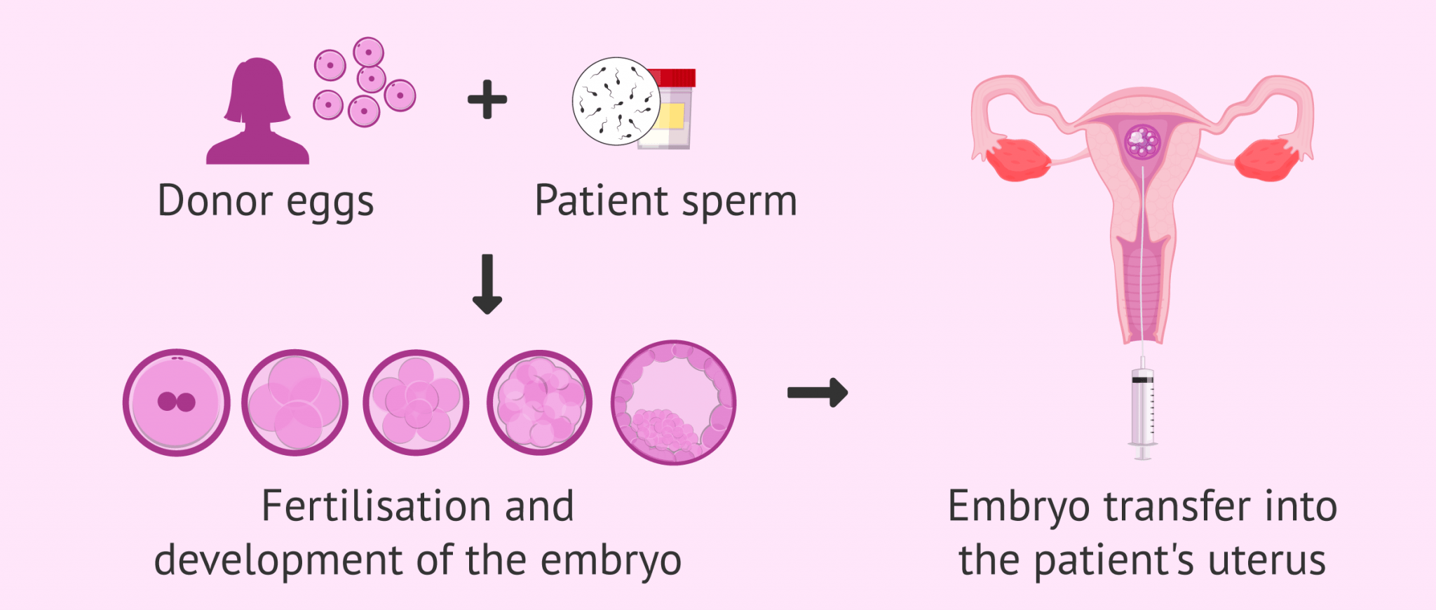 Assisted Reproduction Techniques To Combat Female Infertility