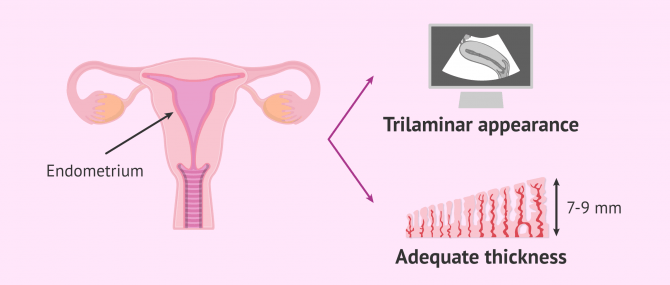 Imagen: Endometrial ultrasound monitoring