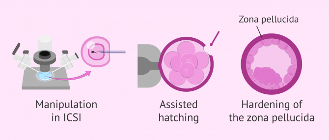 Imagen: What influences the likelihood of twins in IVF?