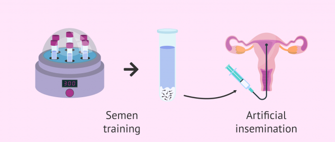 Imagen: Artificial insemination with semen capacitation