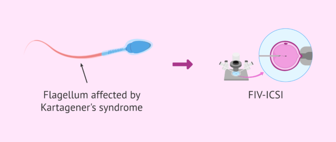 Imagen: Option of achieving pregnancy in males with Kartagener's syndrome