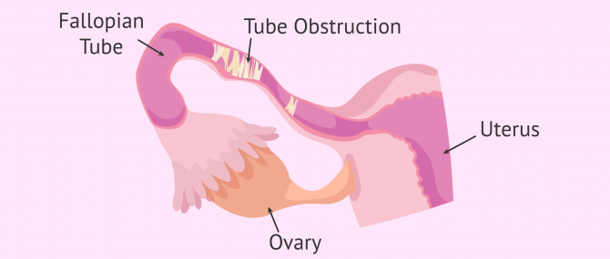 Imagen: Obstructed Fallopian Tubes