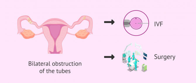 Imagen: Pregnancy with bilateral tubal obstruction