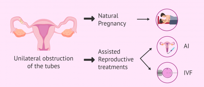 Imagen: Pregnancy with unilateral tubal obstruction