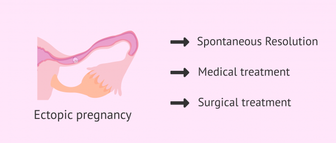 Imagen: Treatment for Ectopic Pregnancy