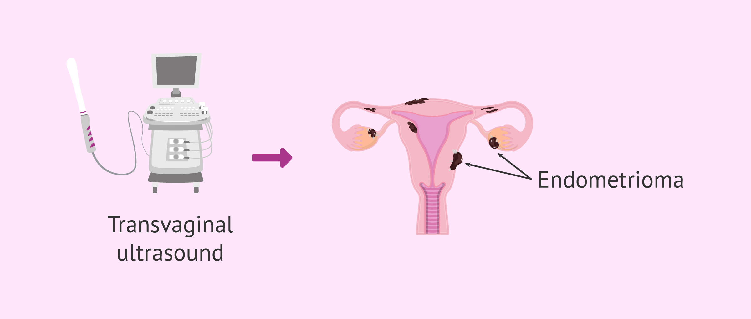 Imagen: Transvaginal ultrasound to detect chocolate cysts