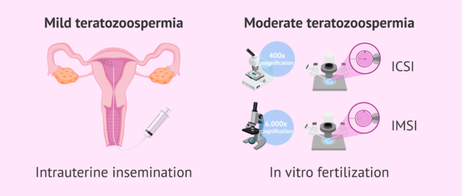 Imagen: Pregnancy with teratozoospermia