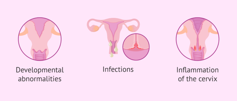 Female infertility due to cervical factor