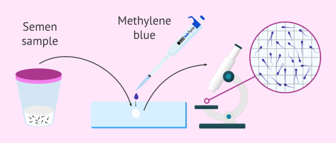 Imagen: How is teratozoospermia diagnosed?