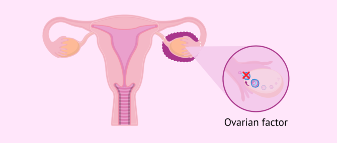 Imagen: Female ovarian factor infertility