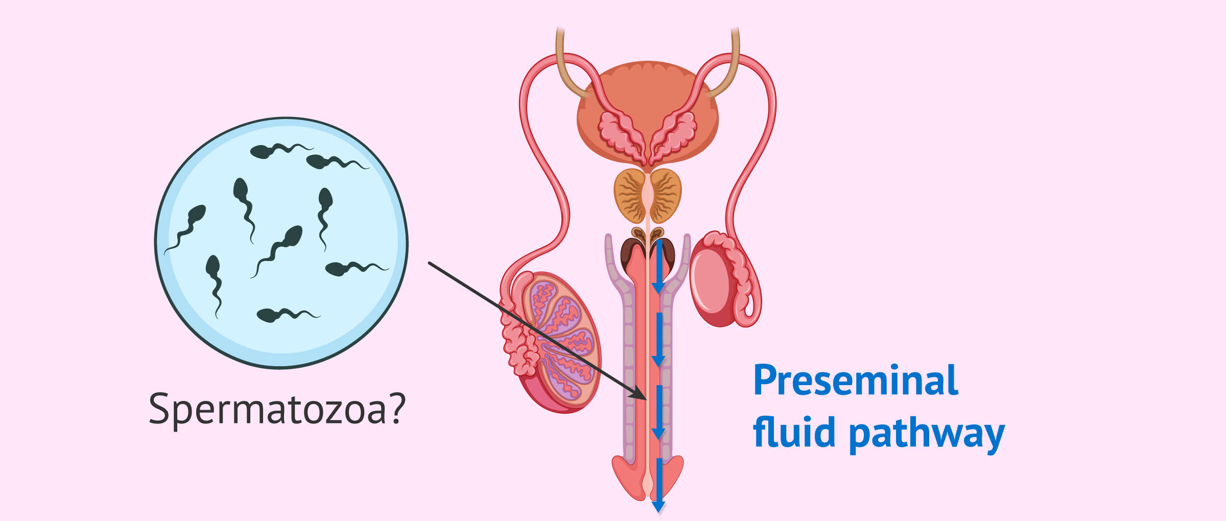 Spermatozoa In Preseminal Fluid