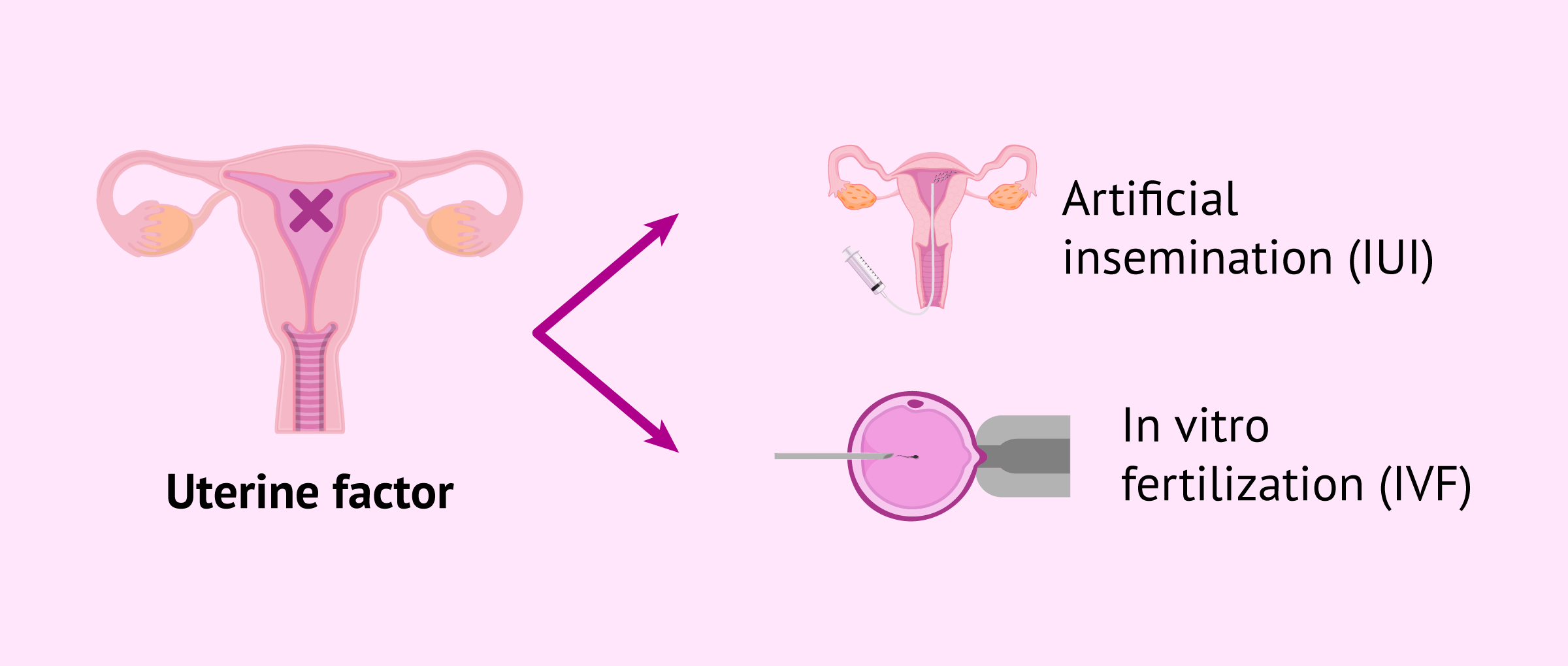 Imagen: Pregnancy with uterine factor infertility