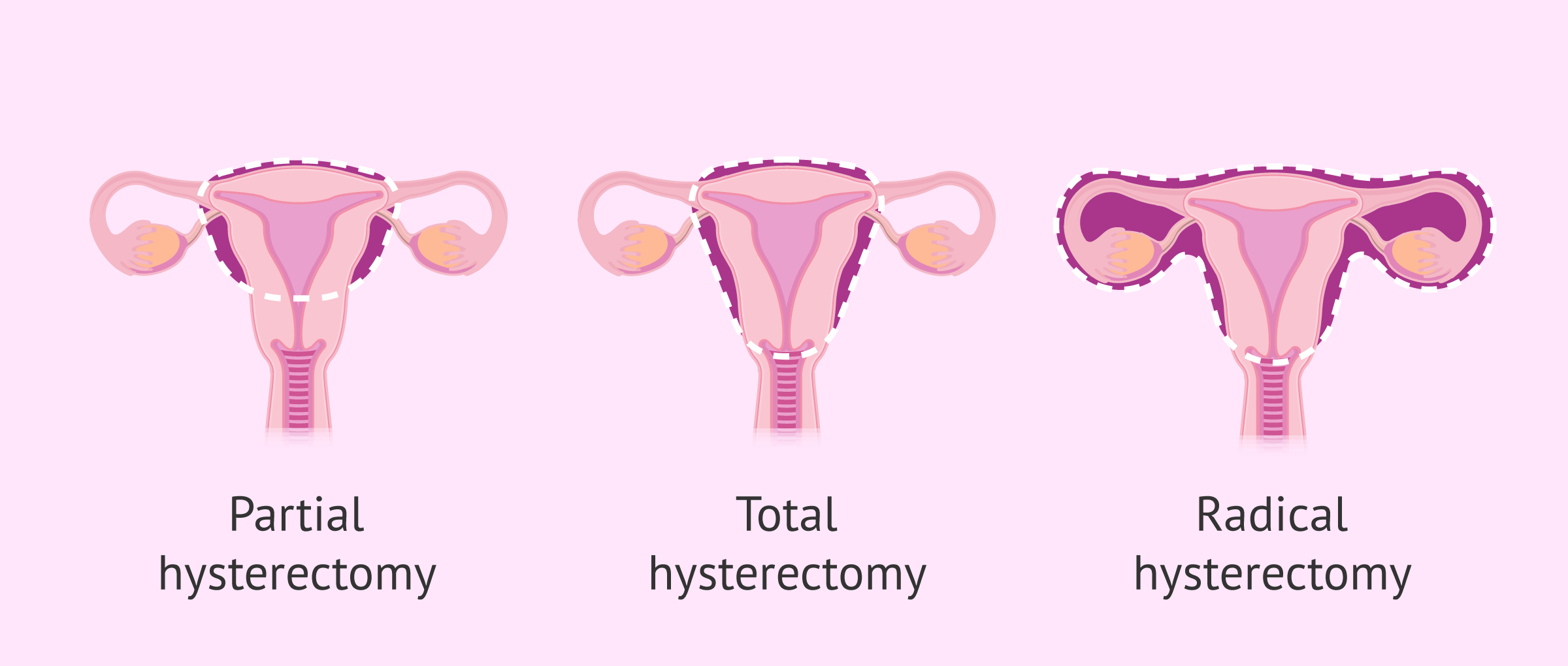 What Is A Hysterectomy 