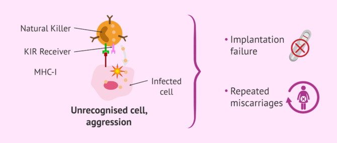 Imagen: Alloimmune infertility due to elevated NK cells