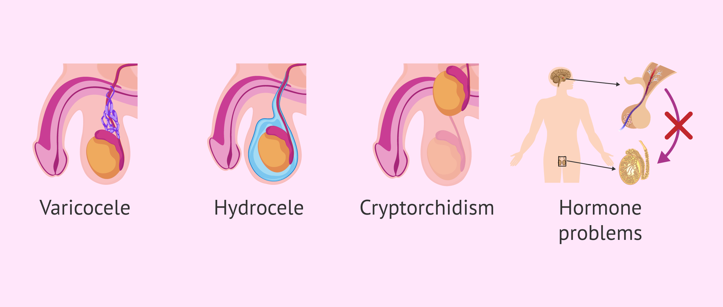 Imagen: Diseases that alter the seminogram