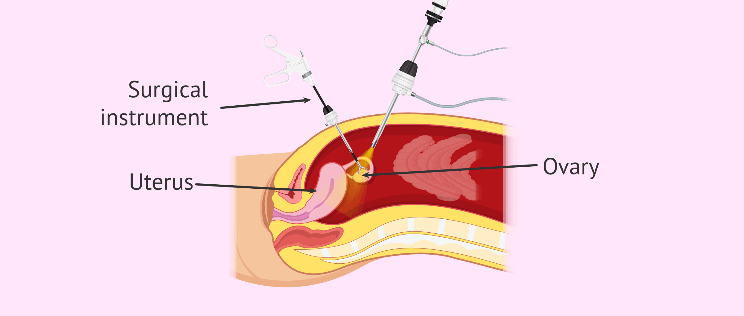 Imagen: oophorectomy-removal-of-ovary