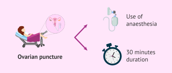 Imagen: Characteristics of ovarian puncture