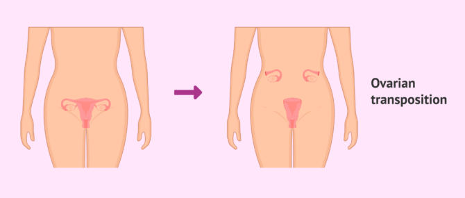 Imagen: What is ovarian transposition?