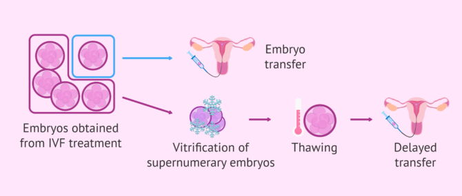 Imagen: Future use of vitrified supernumerary embryos