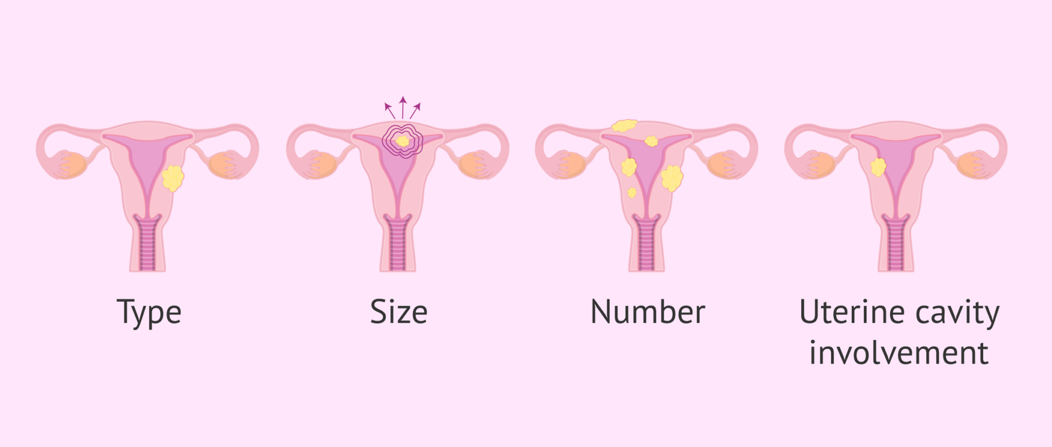 Do Uterine Fibroids Affect Ivf