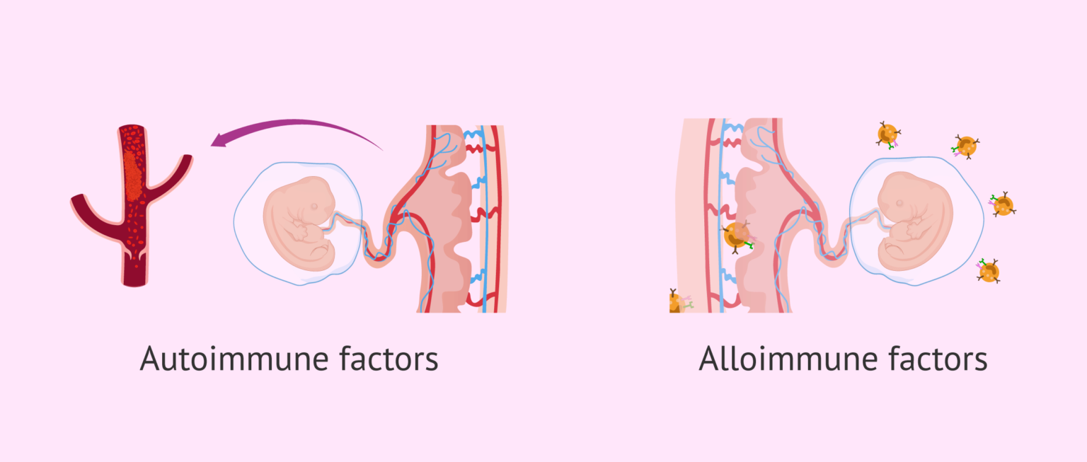 immunological-factors-causing-repeat-miscarriages