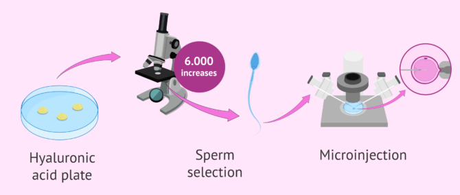 Imagen: PICSI or Physiological ICSI