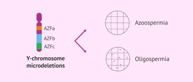 Imagen: Consequences of Y chromosome microdeletions