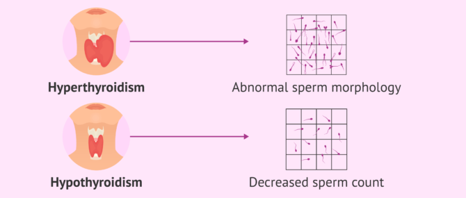 Imagen: Consequences in men with thyroid problems