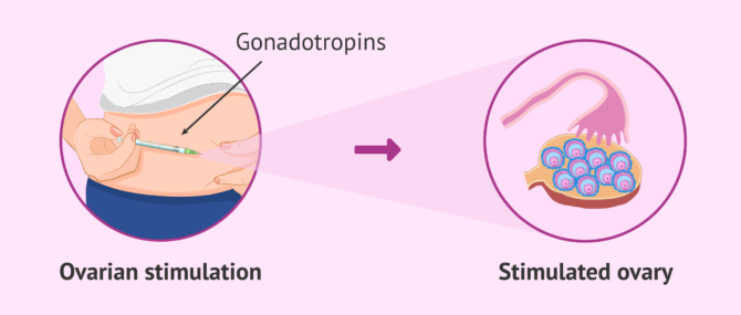 Imagen: Controlled Ovarian Stimulation