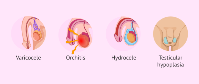 Imagen: Disorders of testicular origin in men