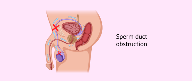 Imagen: Obstruction of the epididymis, vas deferens and urethra