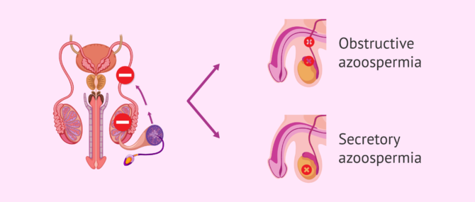 Imagen: Obstructive and secretory low sperm count