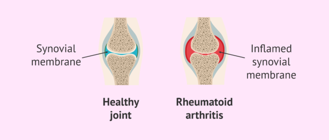 Imagen: Rheumatoid arthritis - an autoimmune disease