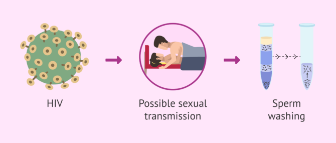 Imagen: Sexual transmission of HIV and assisted reproduction